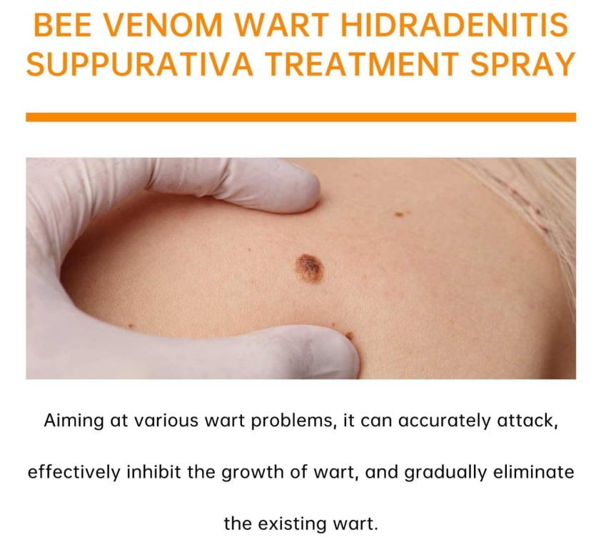 Spray Veneno de Abeja para Eliminar Verrugas
